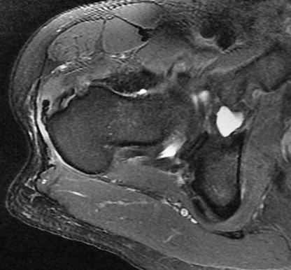 Figure 4 for case Gluteus minimus calcific tendinitis